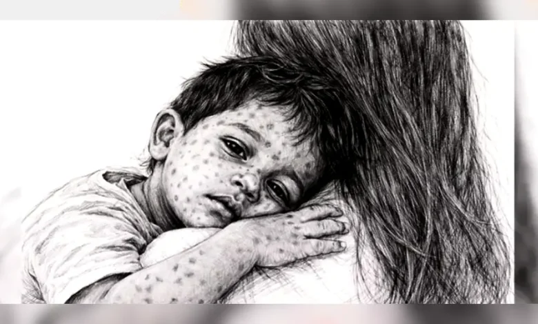 চলতি বছর বিশ্বে হামে মৃত্যুতে শীর্ষে বাংলাদেশ