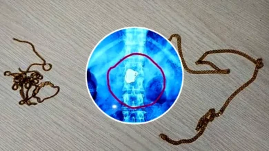 নোয়াখালী হাসপাতালে রোগীর গলা থেকে সোনার চেইন চুরি, এক্স-রেতে পেটে মিলল গয়না